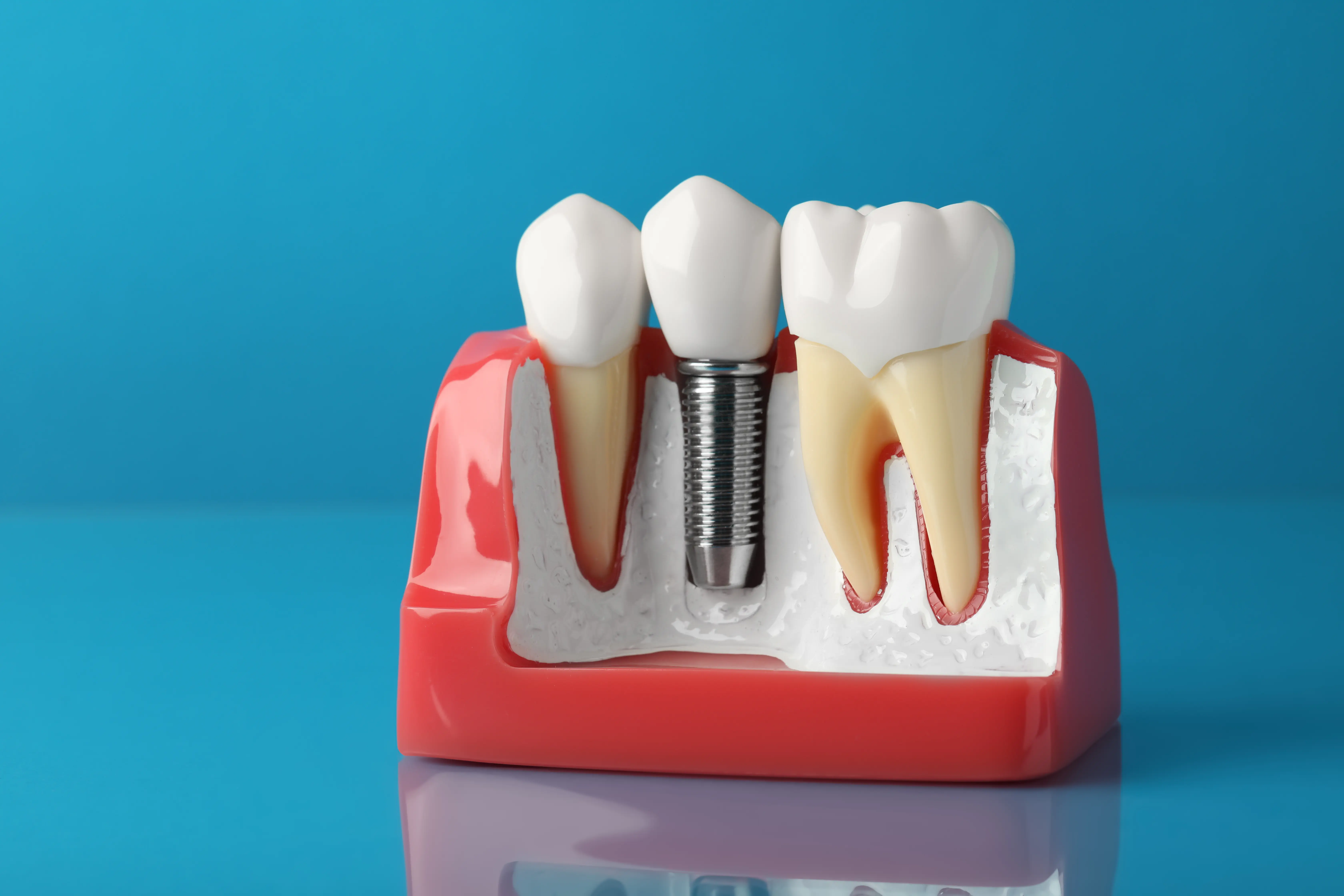 Dental Implant Cost in Singapore Procedure & Subsidies - Newlife Dental Practice