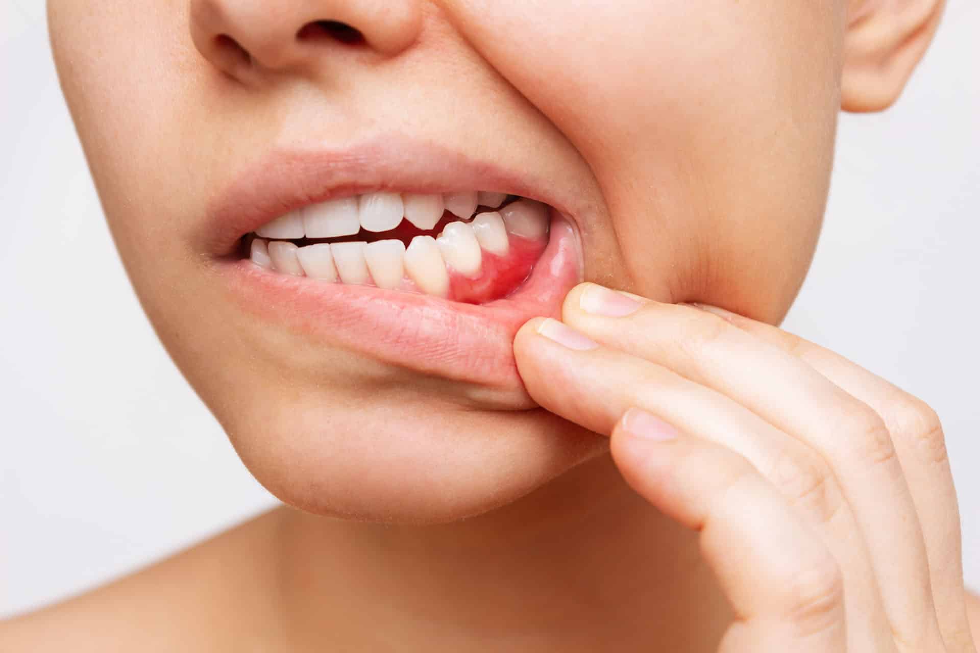 Gum Disease in Singapore - Newlife Dental Practice