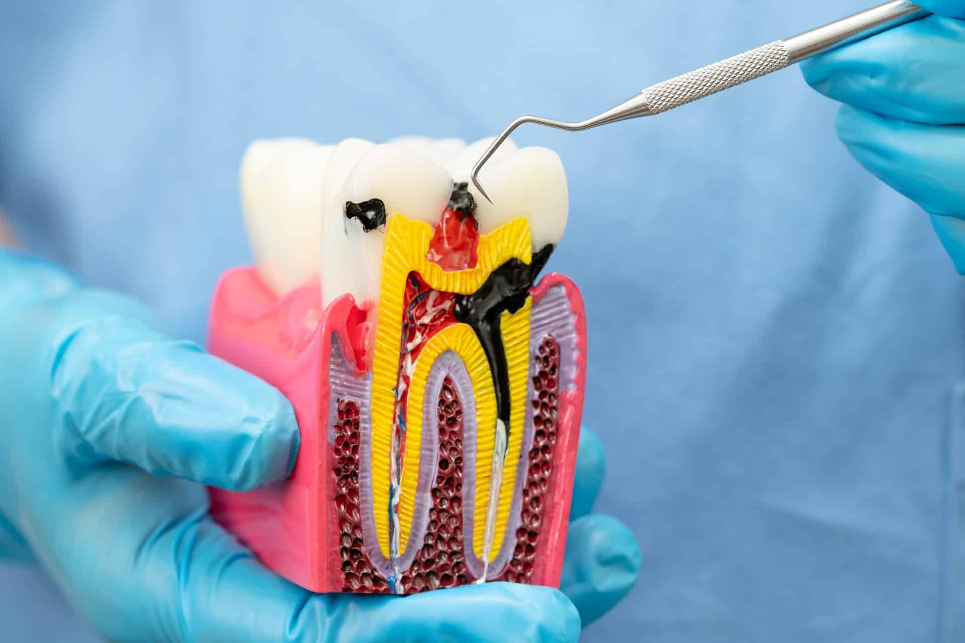 Root Canal Treatment in Singapore - Newlife Dental Practice