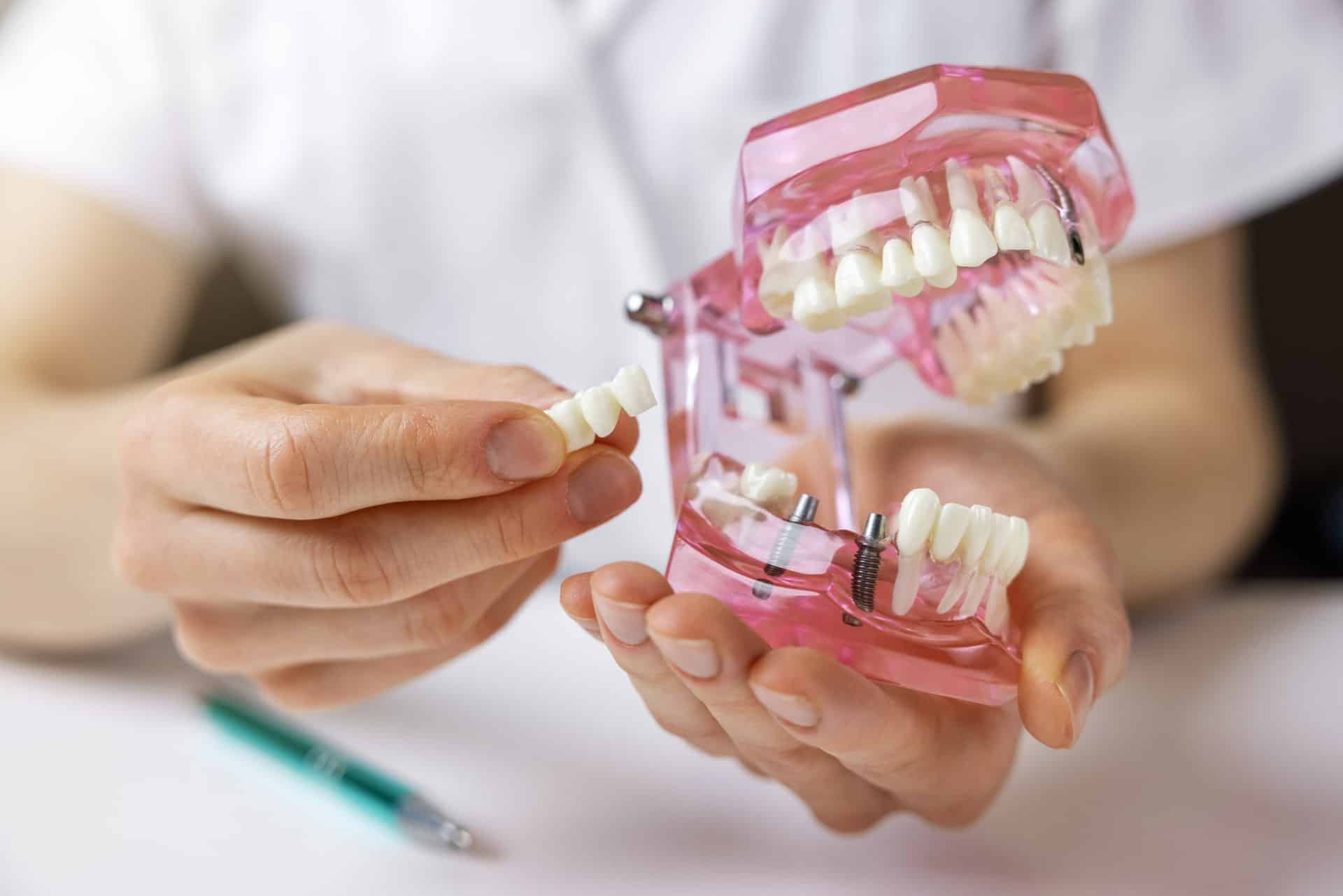 Dentist showing the different types of dental implants on a jaw model - Newlife Dental Practice