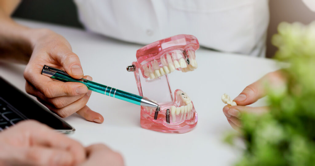 Ultra-Short & All-on-4 Dental Implants in Singapore - Newlife Dental Practice