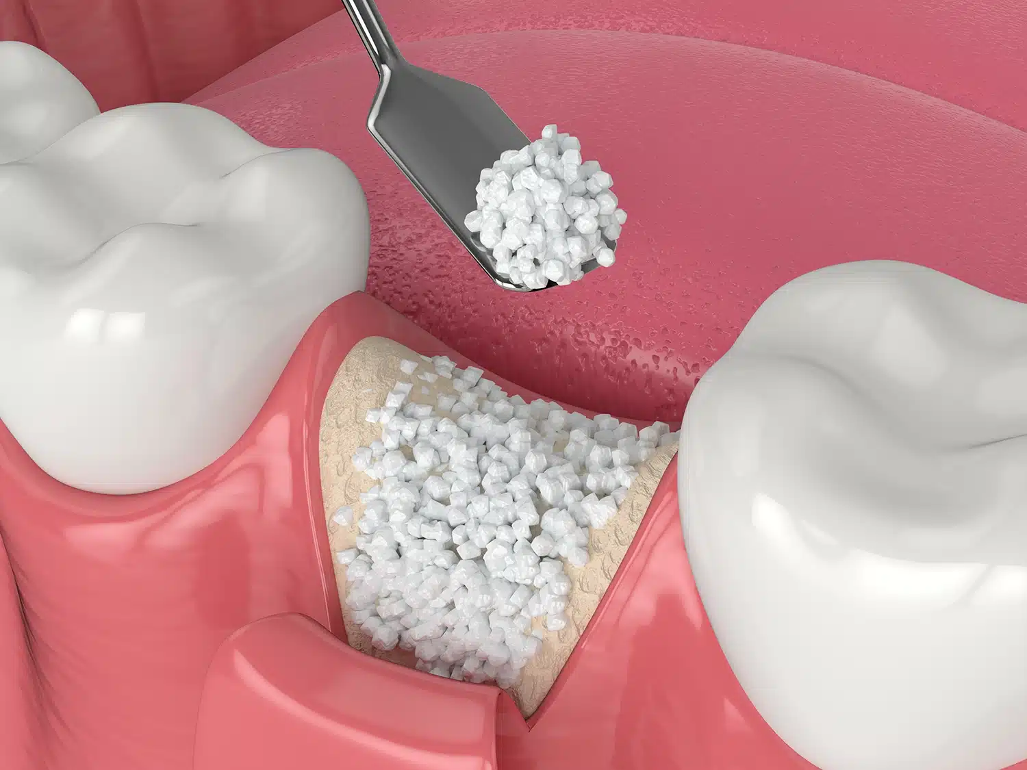 Bone grafting for dental implants in Singapore - Newlife Dental Practice
