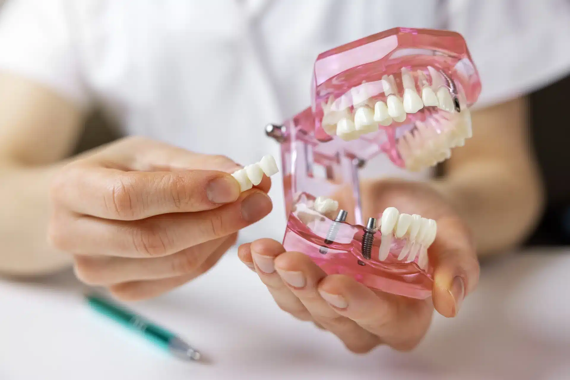 A dentist showing dental implants on a tooth and jaw model - Newlife Dental Practice